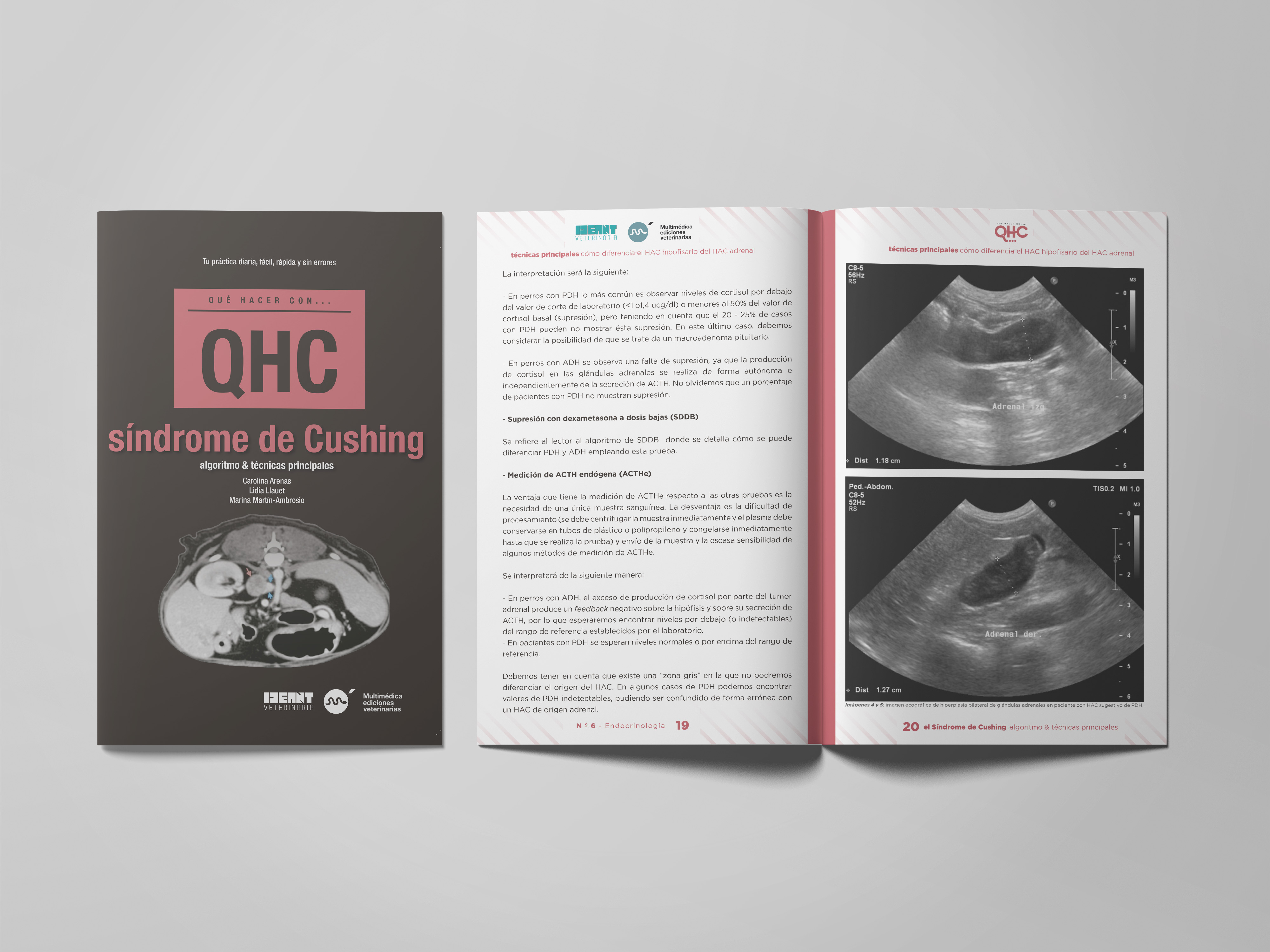 Revista QHC Síndrome de Cushing